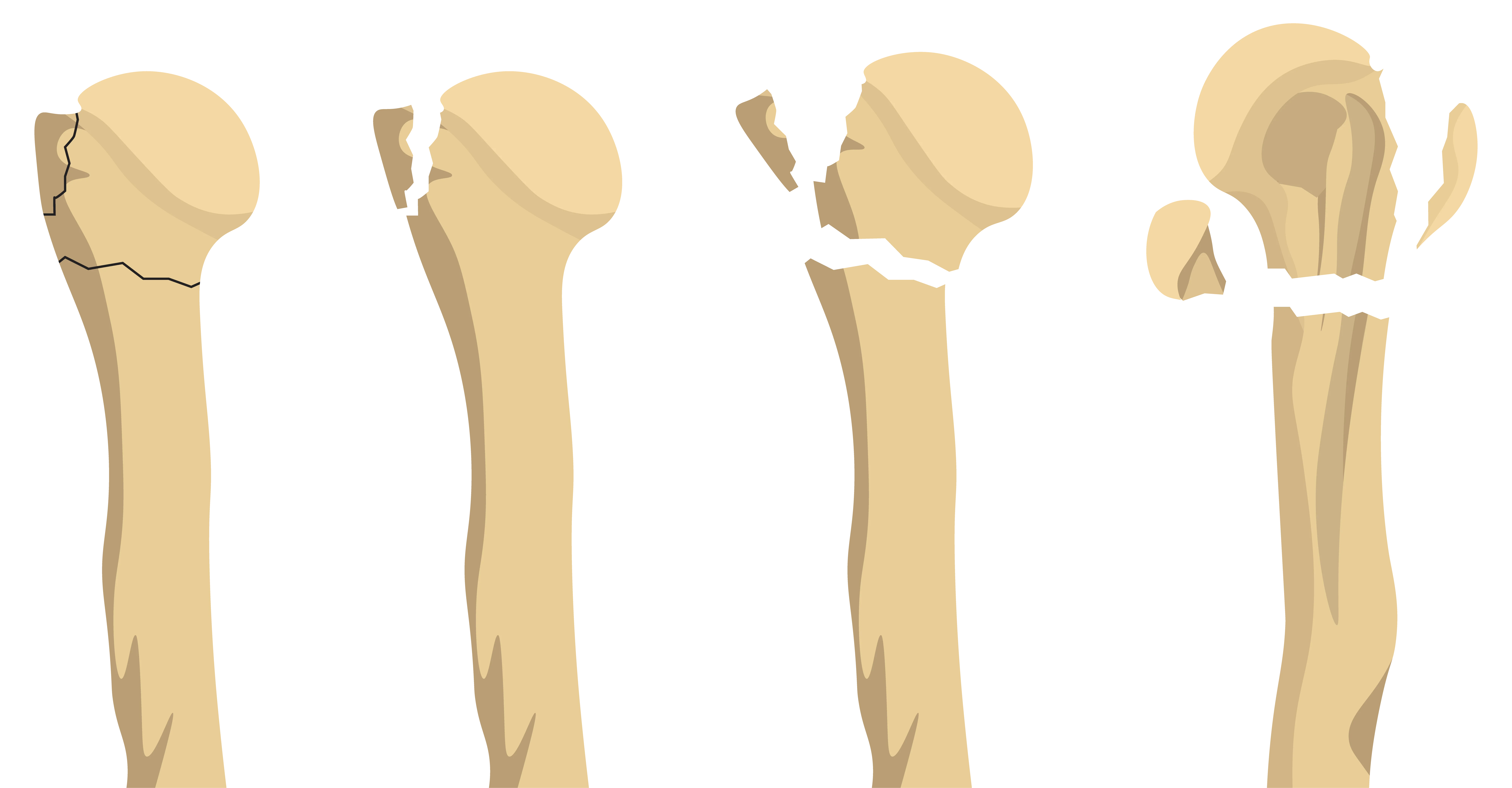 Neer System for classifying shoulder fractures