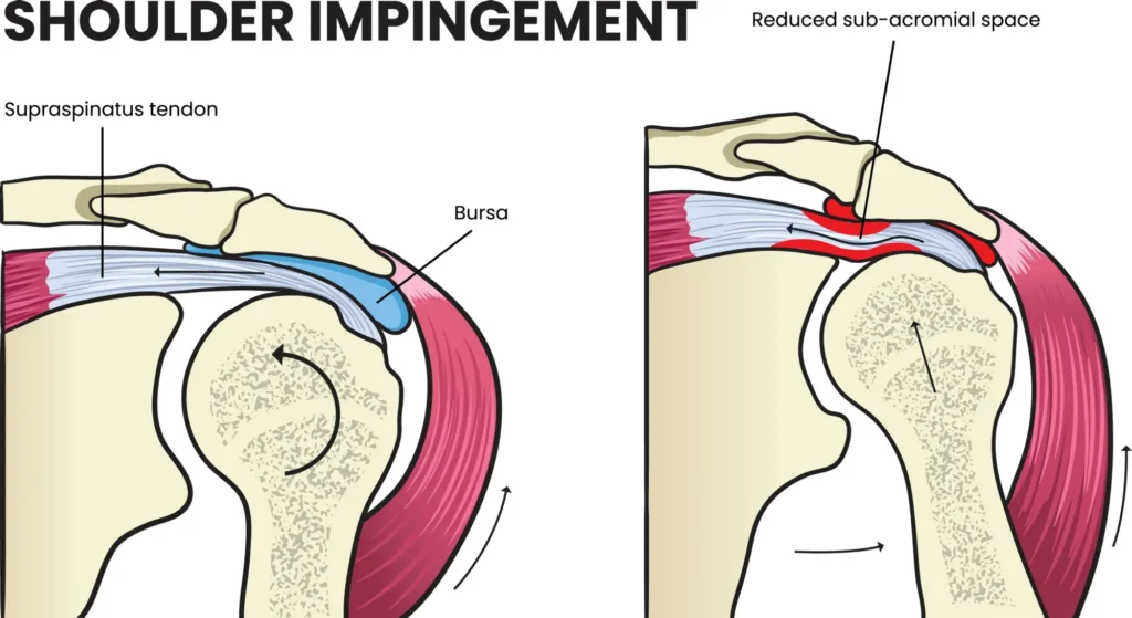 Diagram of shoulder impingement