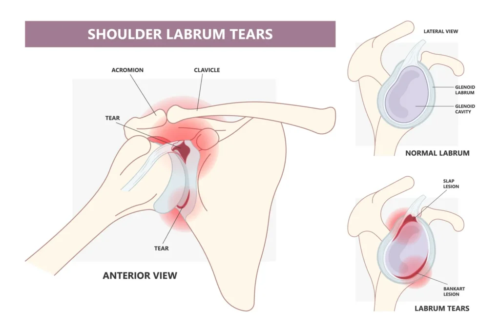 Diagram of shoulder labrum tears