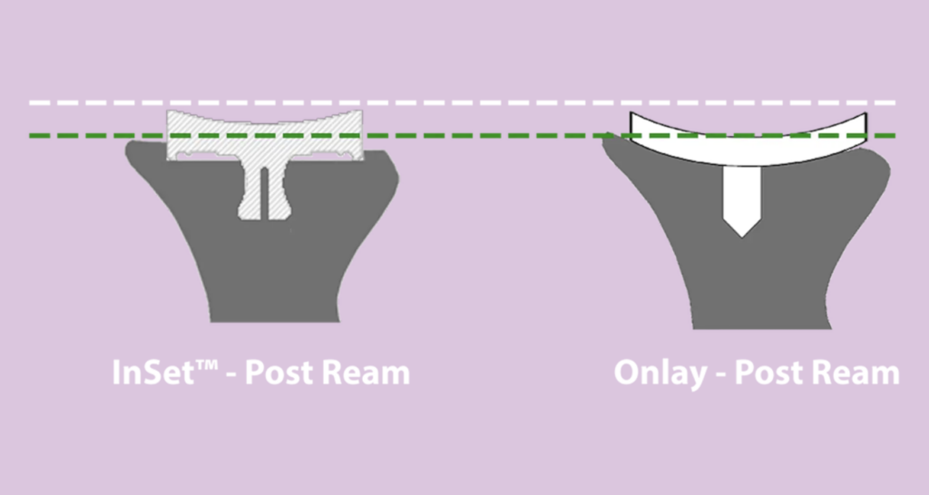 in set post ream versus Onlay post ream