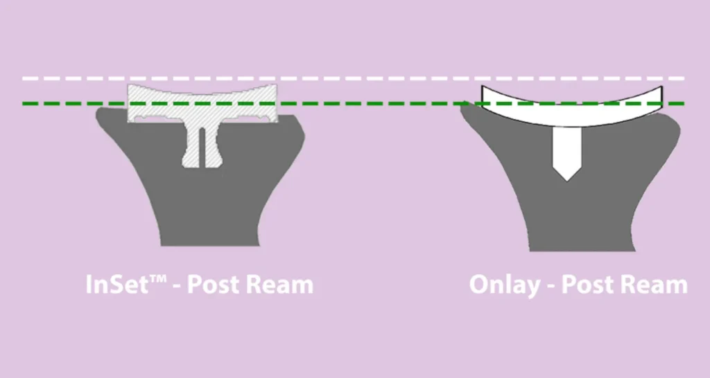 InSet Diagram in set post ream versus Onlay post ream comparison diagram