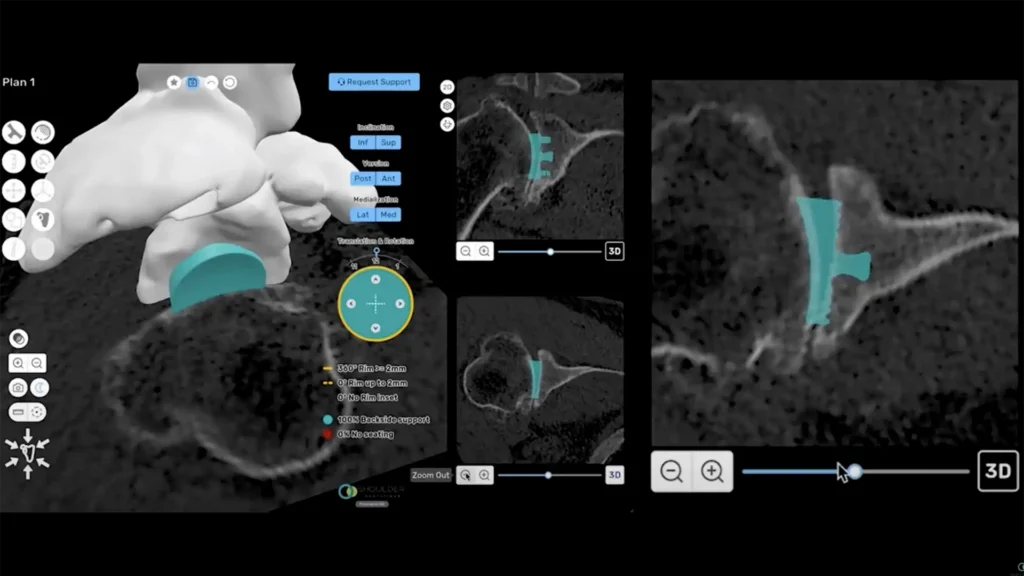 ProVoyance® TSA planning with glenoid