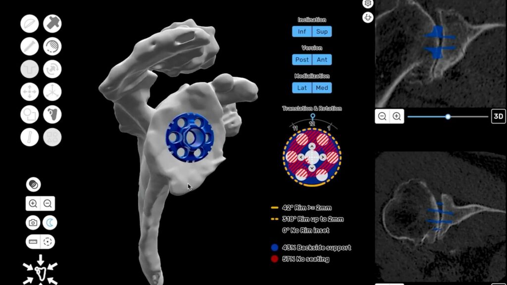 ProVoyance Pre-Op Planning RSA ProVoyance 3D surgical planning for reverse shoulder replacement surgery.