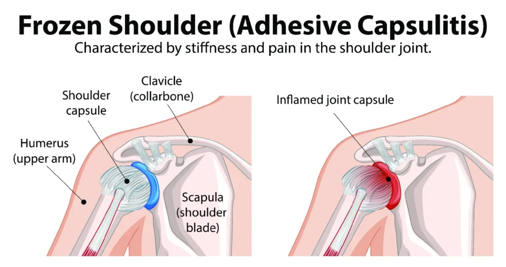 diagram of the inner workings of a frozen shoulder, showing the difference between a normal and inflamed joint capsule.