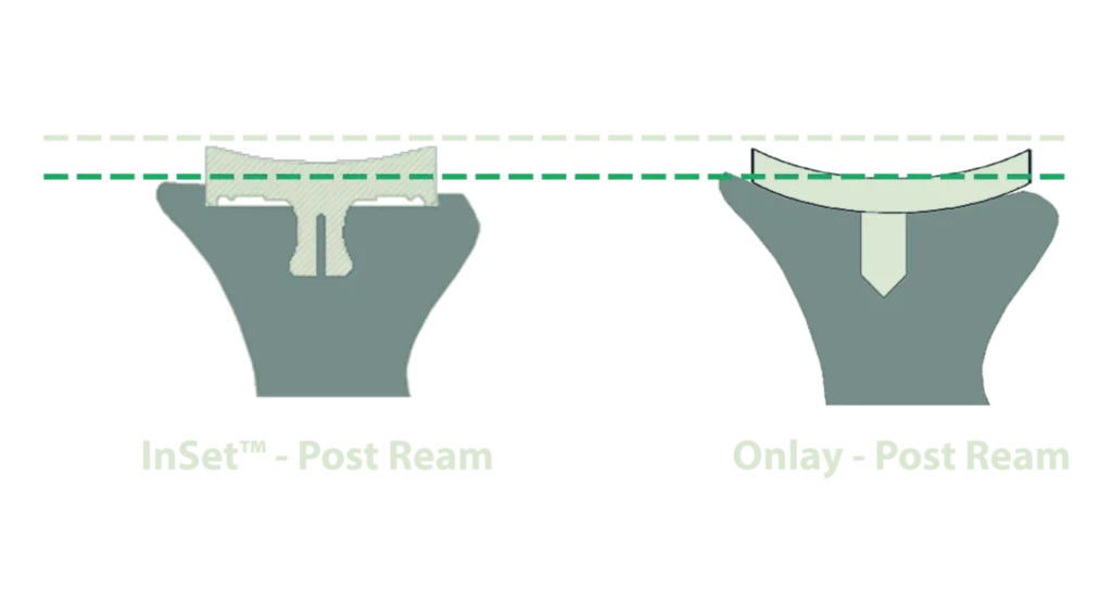 glenoid-loosening diagram showing differences between InSet and Onlay post ream.