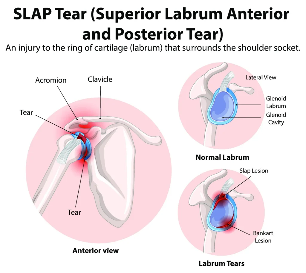 SLAP Tear Diagram SLAP tear diagram comparing a healthy shoulder to an injured shoulder with a labrum tear.