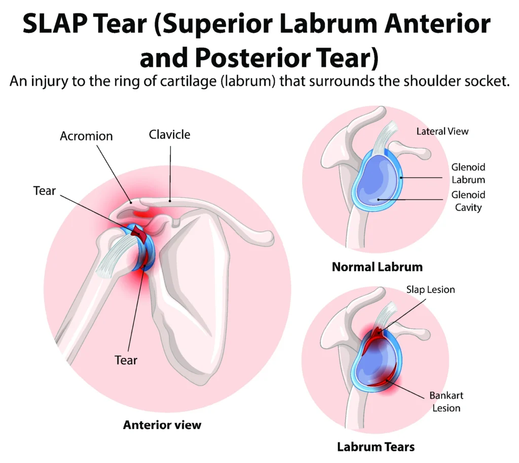 SLAP Tear Diagram SLAP tear diagram comparing a healthy shoulder to an injured shoulder with a labrum tear.