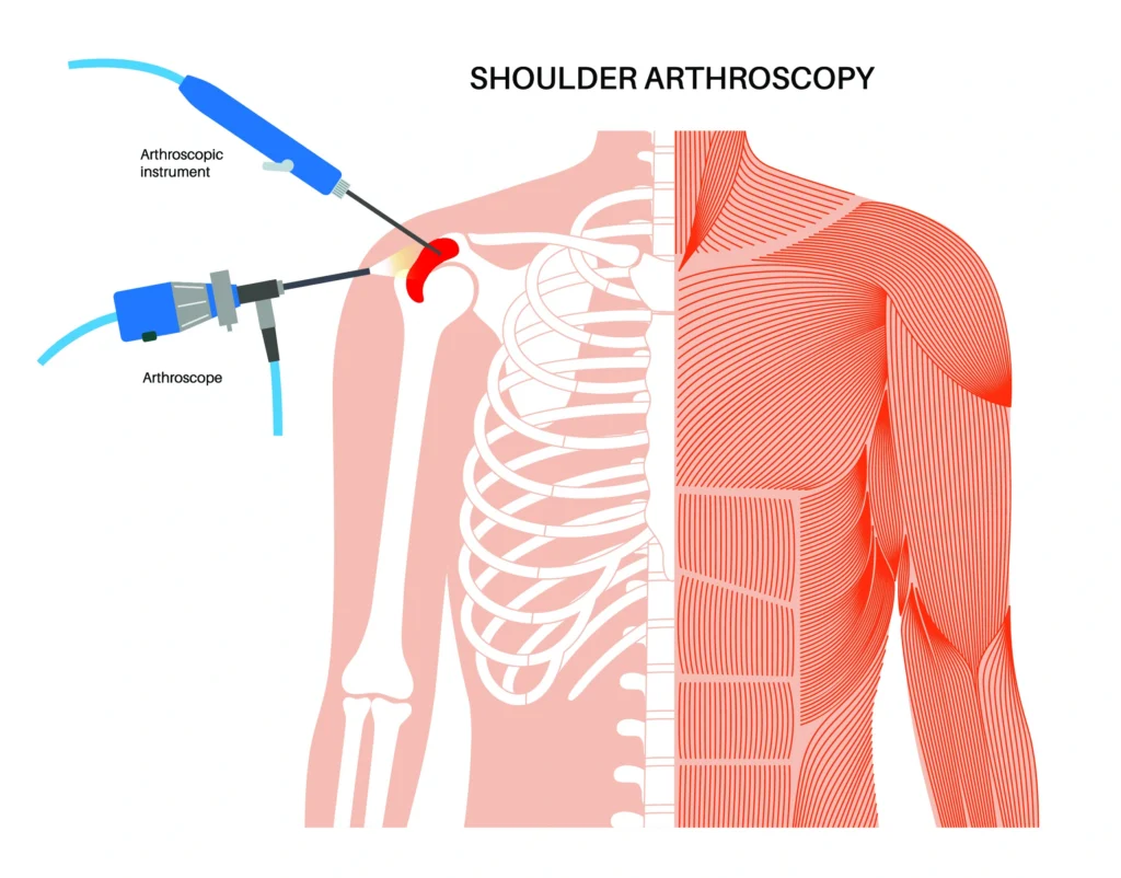 shoulder arthroscopy diagram of a shoulder arthroscopy procedure and the technology used.