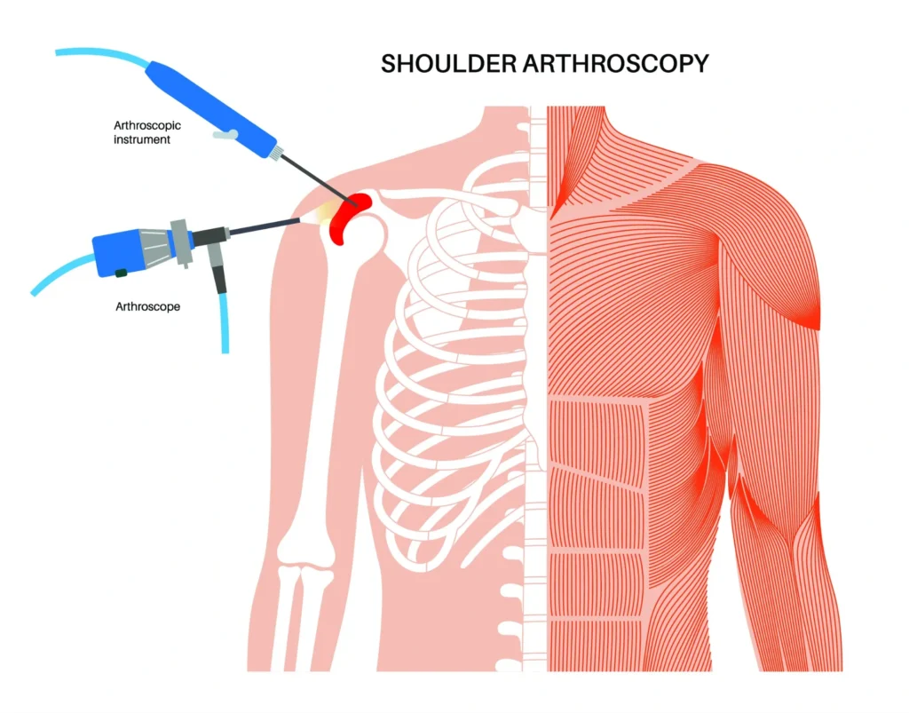 diagram of a shoulder arthroscopy procedure and the technology used.