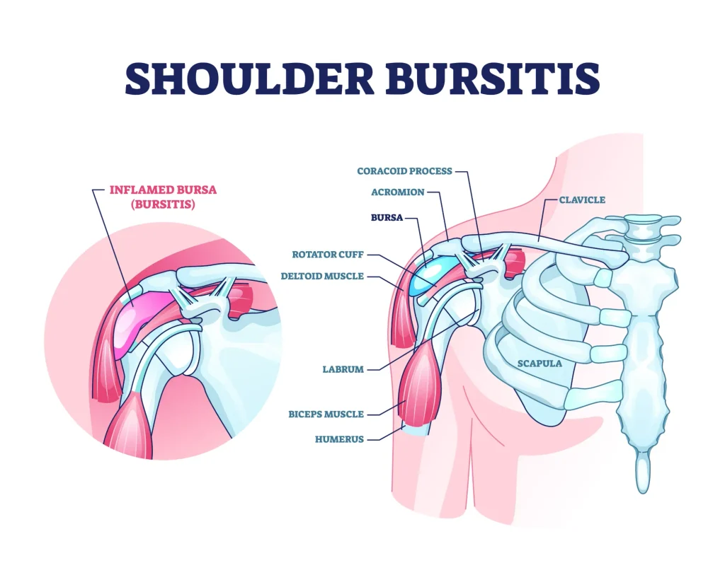 Diagram of shoulder bursitis