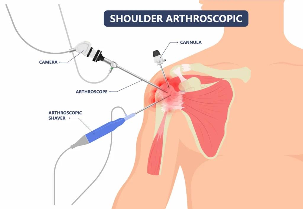 Rotator cuff repair diagram